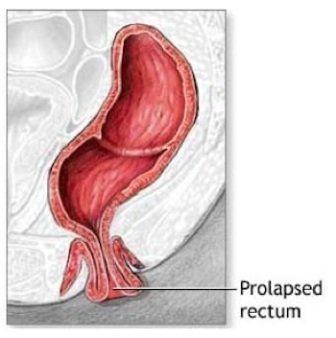 Can rectum stretch after anal sex