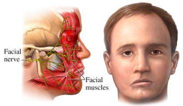 Lifesaver reccomend Involunatary facial muscle contractures