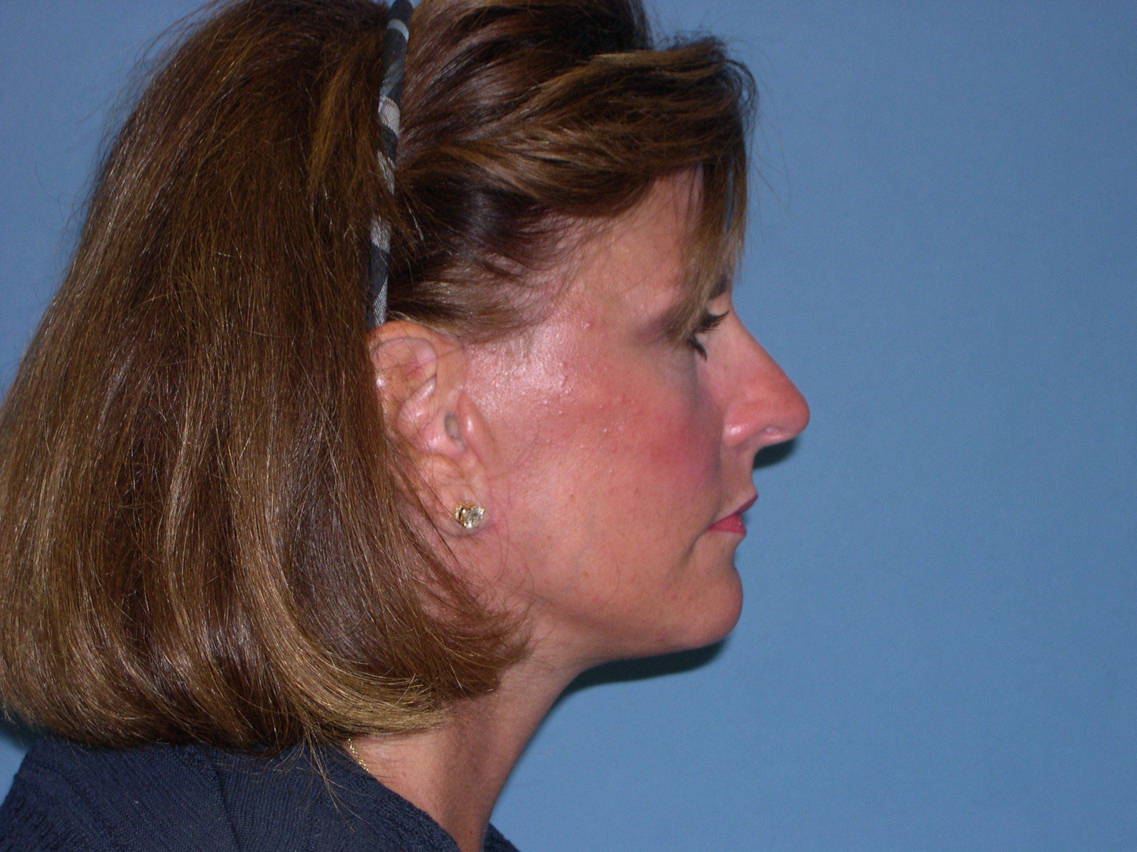 Bradenton facial implants