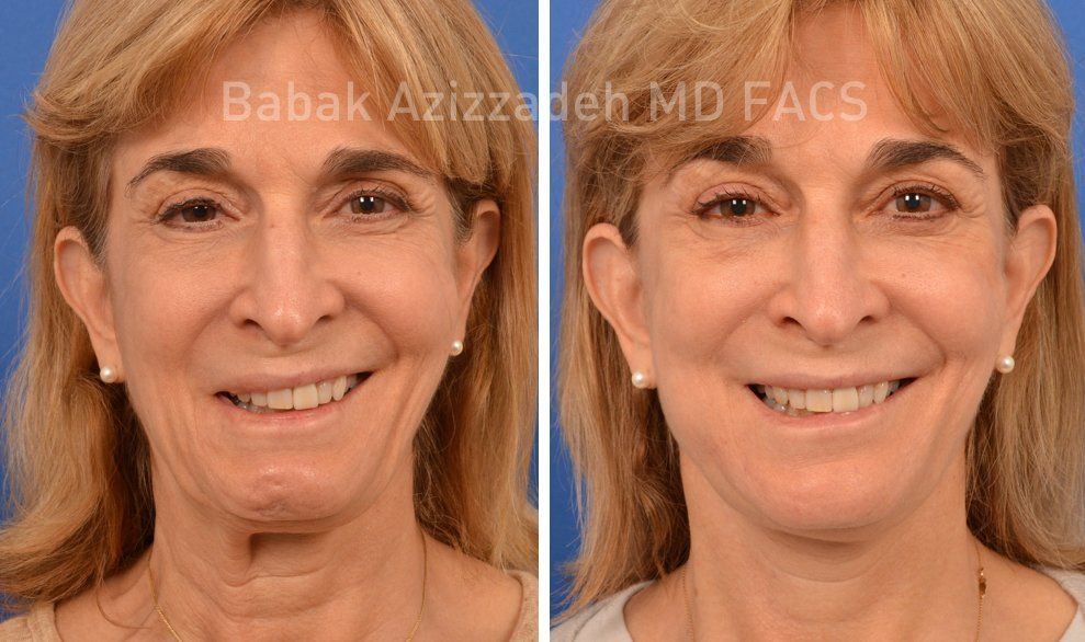 best of Facial muscle contractures Involunatary