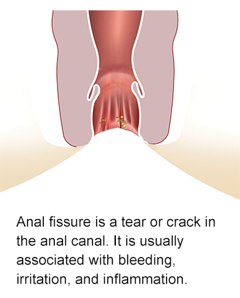 Devil reccomend Anal fissures cause anal itch