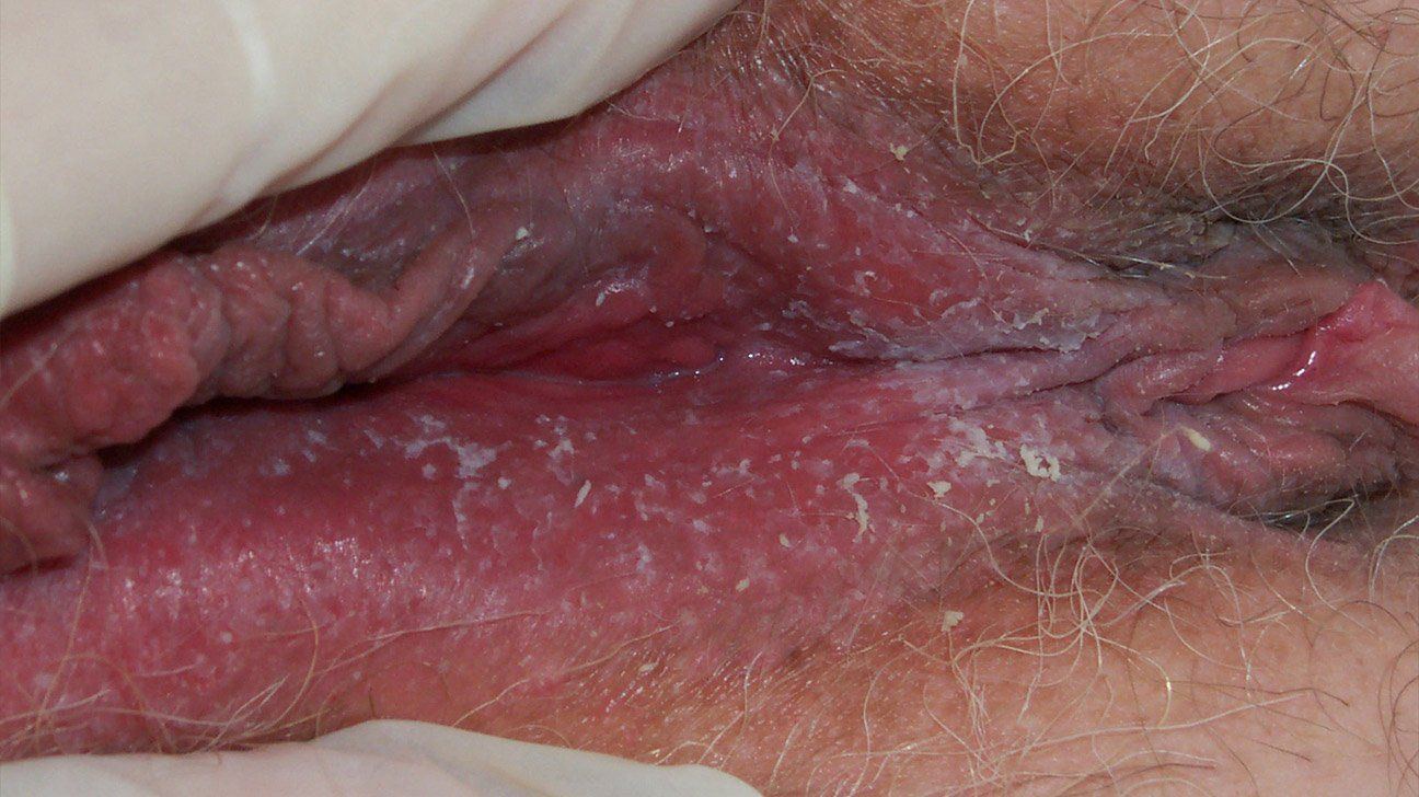 best of By Vaginal caused diseases sex not