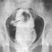 Xray of gay anal penetration