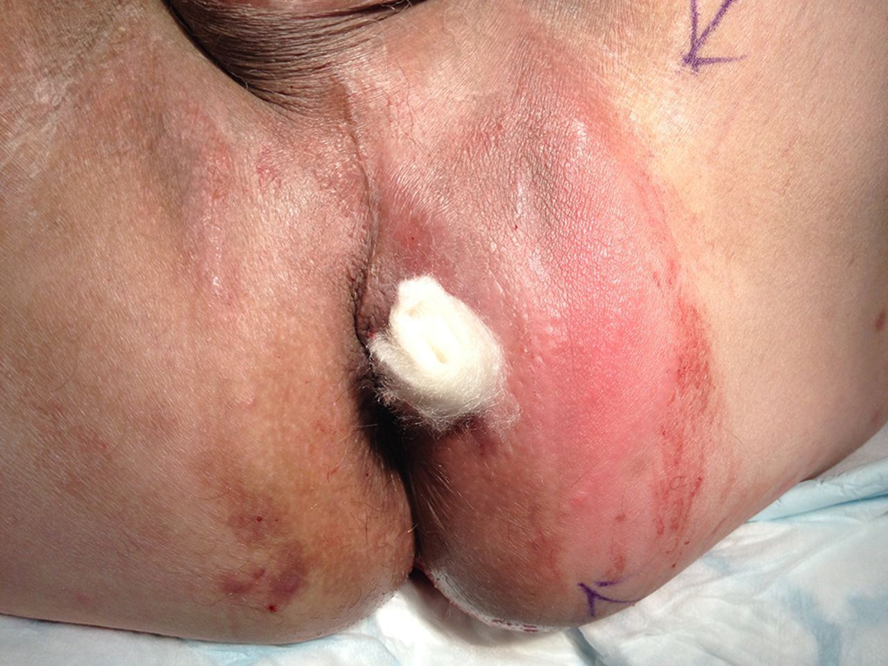 Leather reccomend Anal abscess drainage