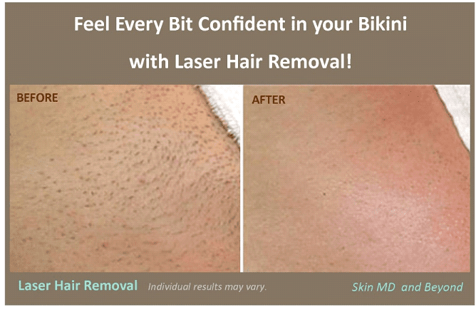 Laser hair full bikini hair removal