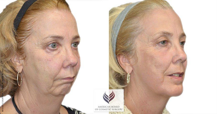 The T. reccomend S lift facial procedure photos