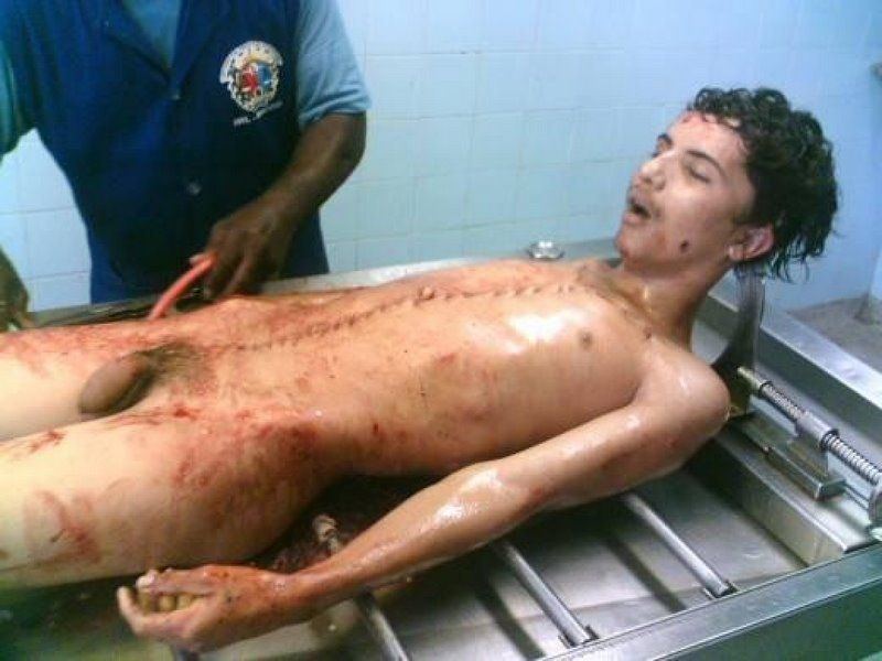 Nude young man in autopsy