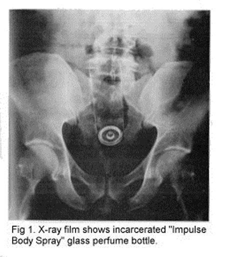 Frog reccomend Xray of gay anal penetration