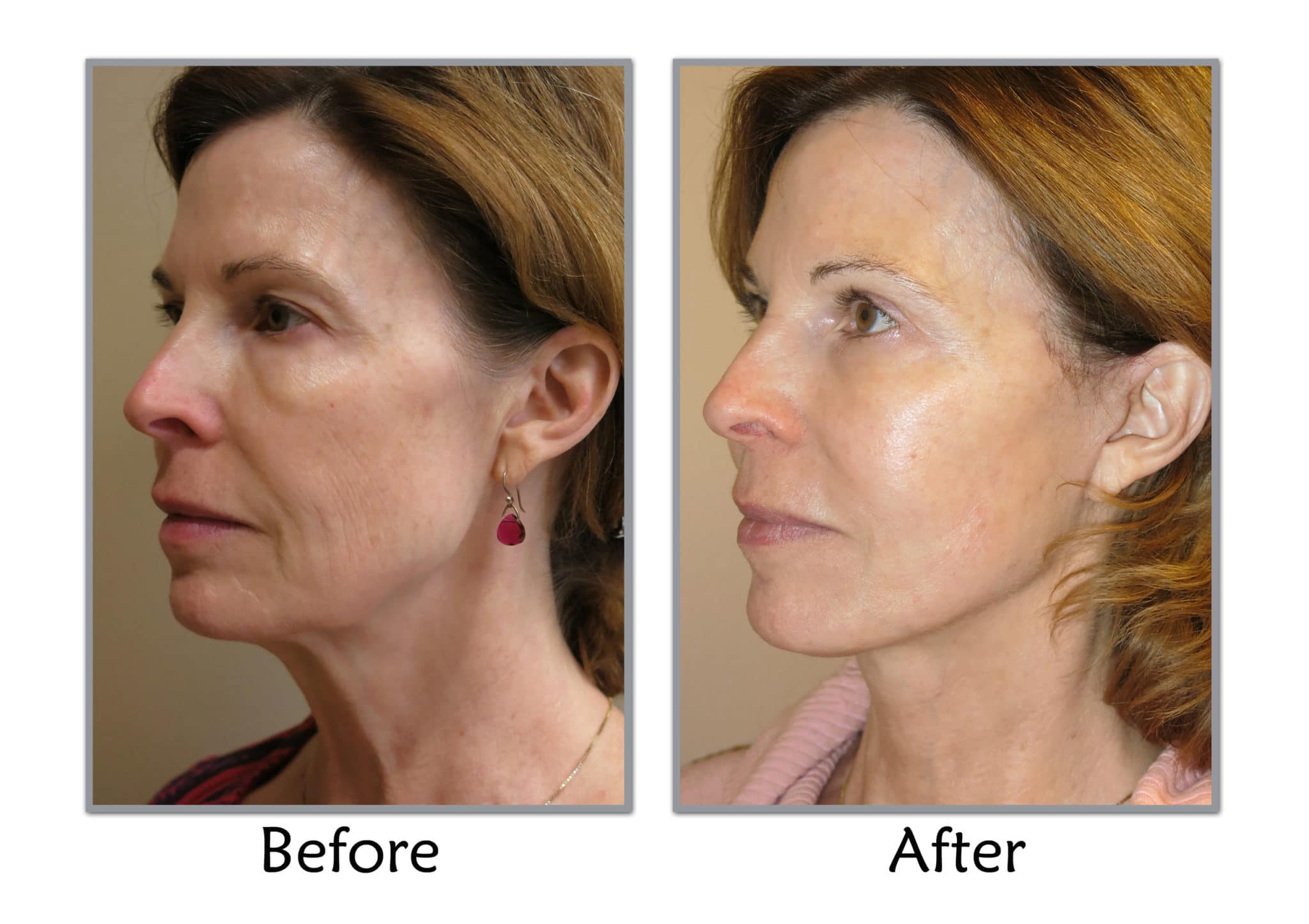 S lift facial procedure photos