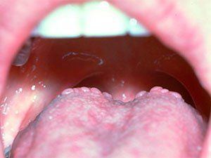 Warts in your mouth