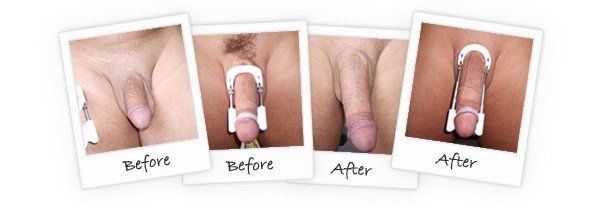 best of Nude Penis and after enlargement before