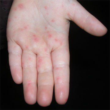 Hand and mouth disease in adults