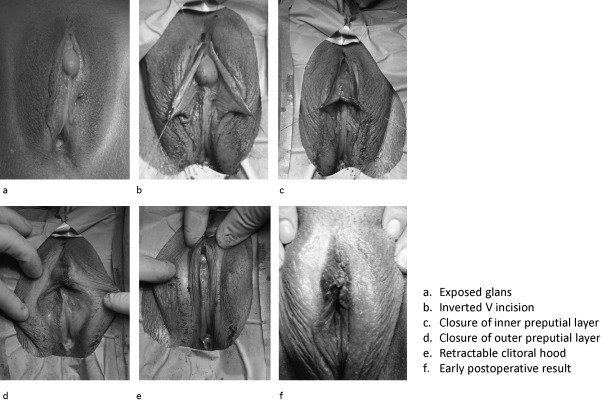 Venom reccomend Prepubescent clitoral stimulation