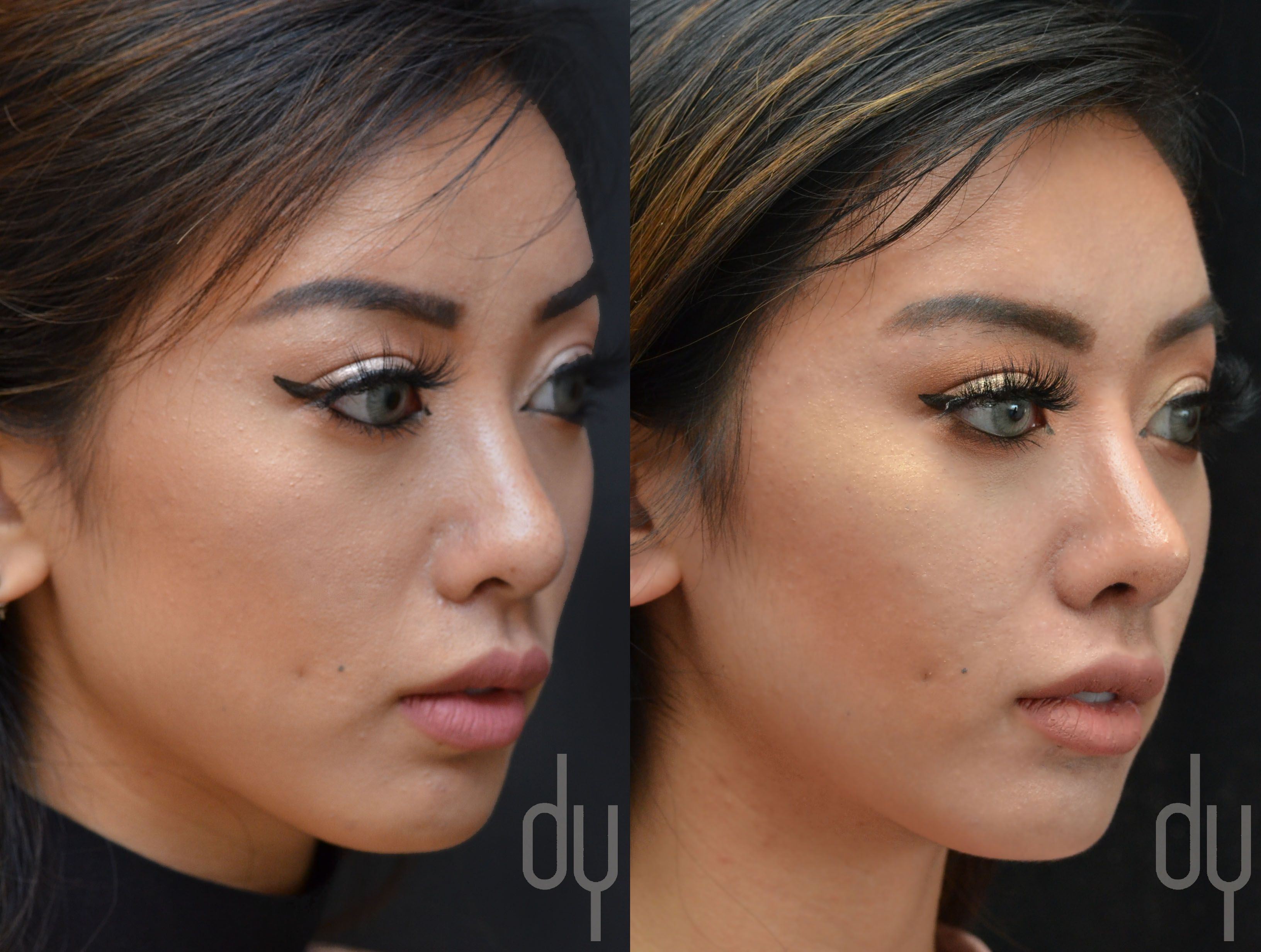 Asian rhinoplasty before and after pictures