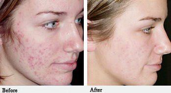 best of For scarring Treatment facial