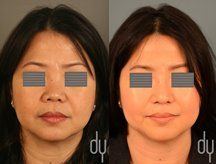 Asian rhinoplasty before and after pictures