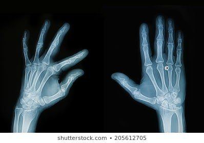 best of Adult hand left Xray male