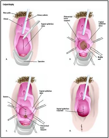 best of Vagina the Colonoscopy of