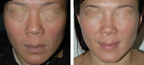 best of Before pictures and rhinoplasty Asian after