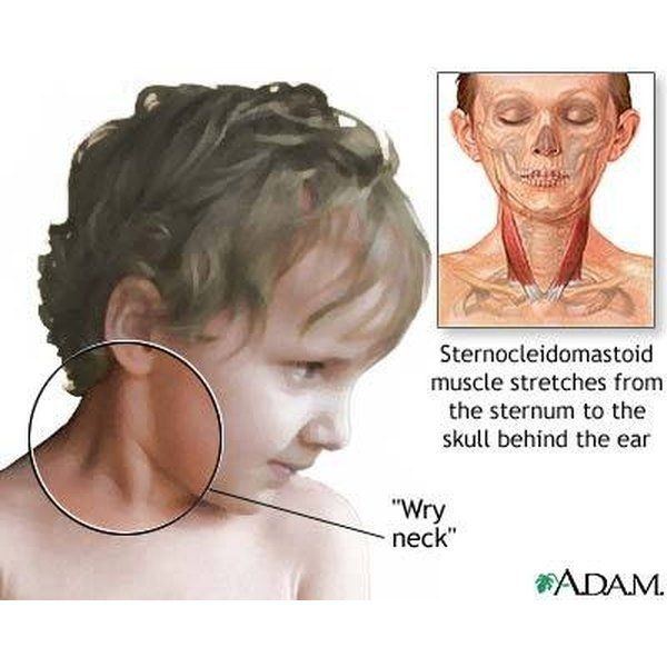 Asymmetry facial torticollis
