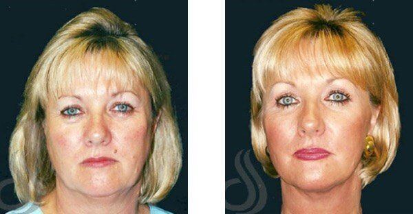 Doodle reccomend S lift facial procedure photos