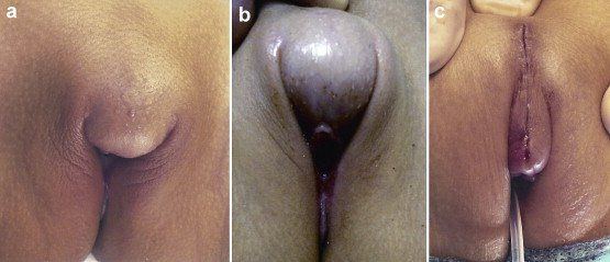 best of Pics Clitoris enlargement