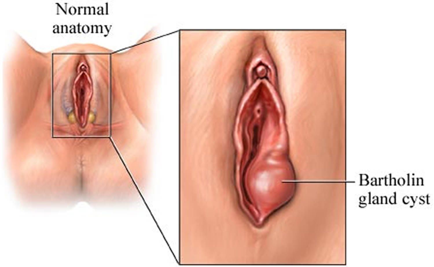 best of The vagina in area Cysts