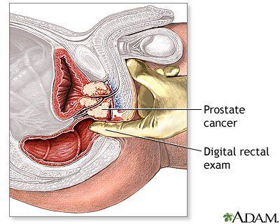Is an anal prostate test accurate