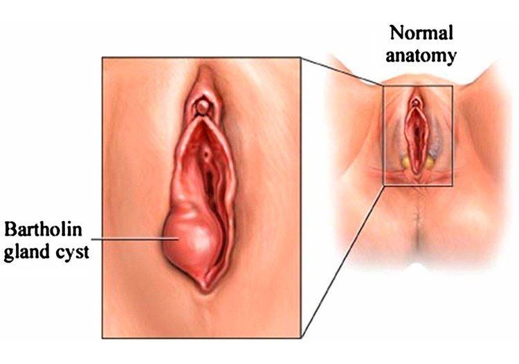 best of The vagina in area Cysts