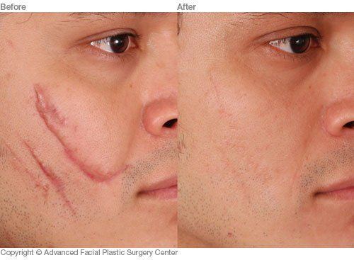 best of Scars surgery from lesion Facial plastic