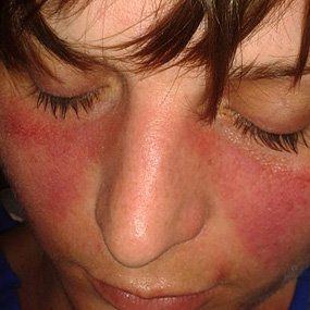 Glitzy reccomend Facial pain with lupus