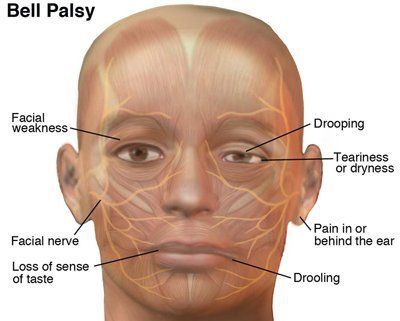 best of Disease Facial lymes paralysis from