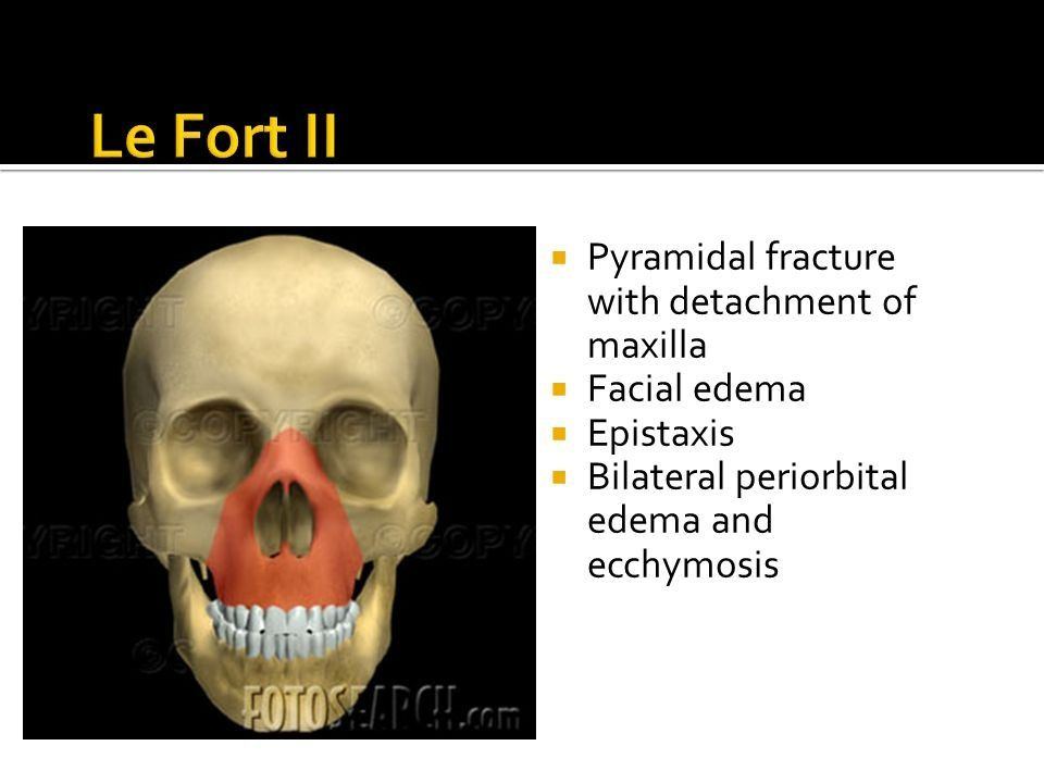 Facial fractures and paralytics