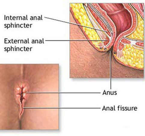 Fissure in anus