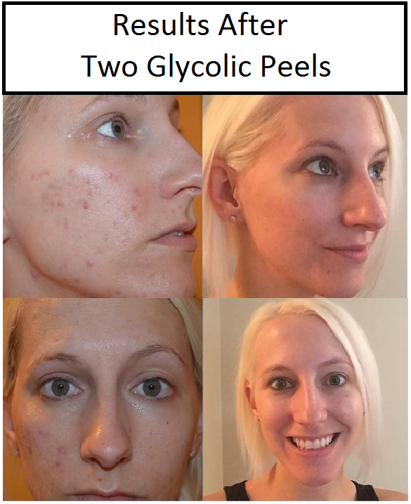 best of Peels Glycolic acid facial