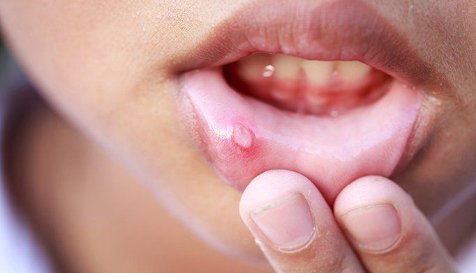 Pecan reccomend Hand and mouth disease in adults
