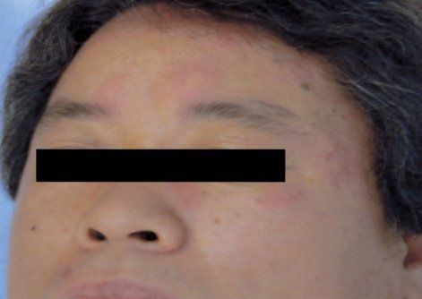 best of Facial rash Maya
