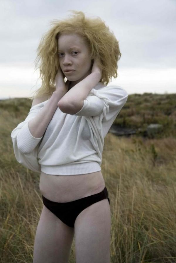 Aqua reccomend Naked albino black people