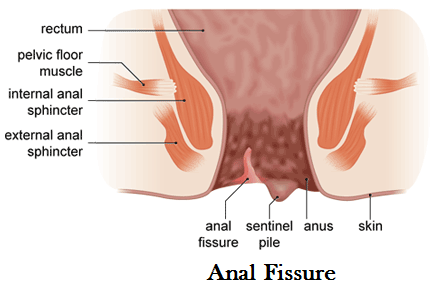 best of For procedures New anal fisures medical