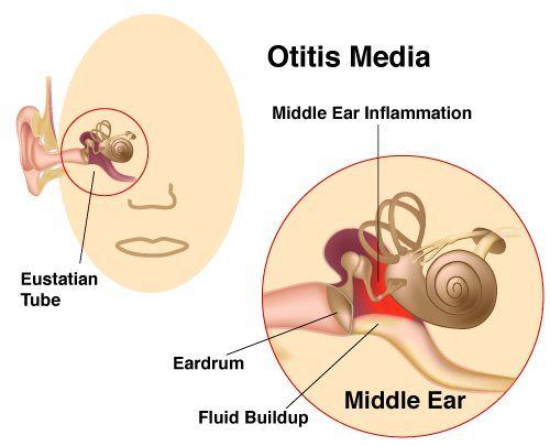 Otitis media in adults treatment