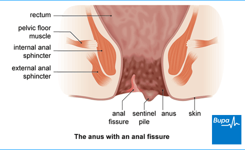Subzero reccomend Painful anal fissure