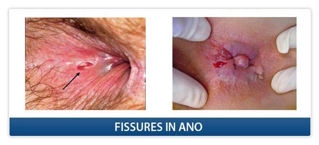 Painful anal fissure