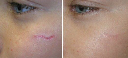 Treatment for facial scarring