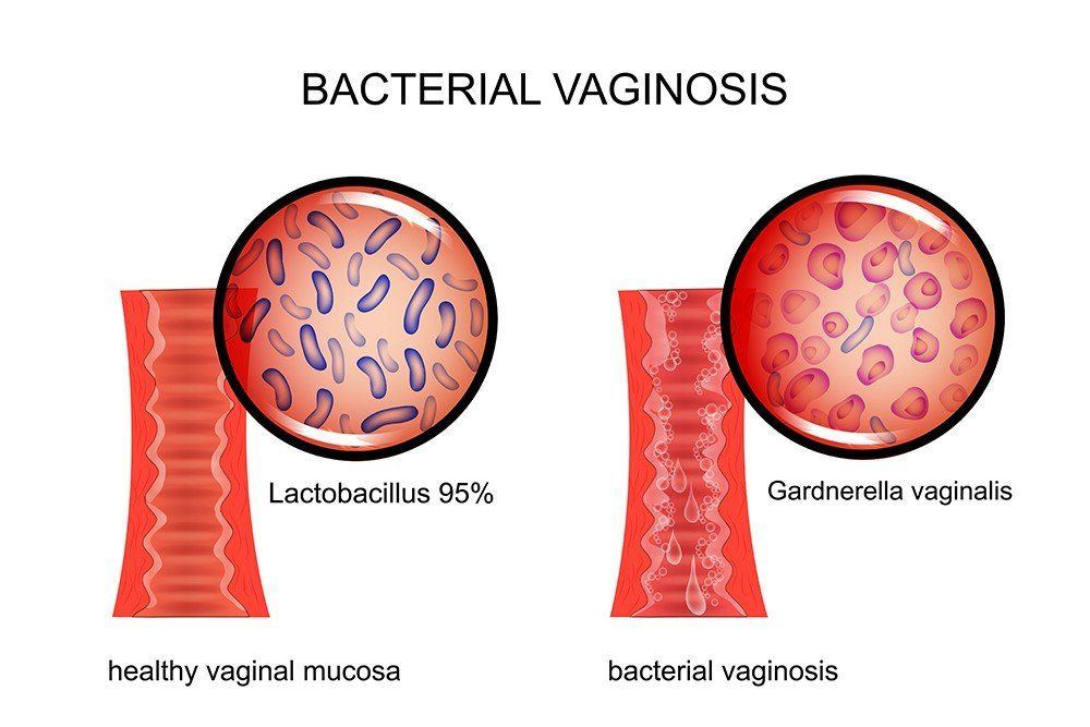 Vaginal diseases not caused by sex