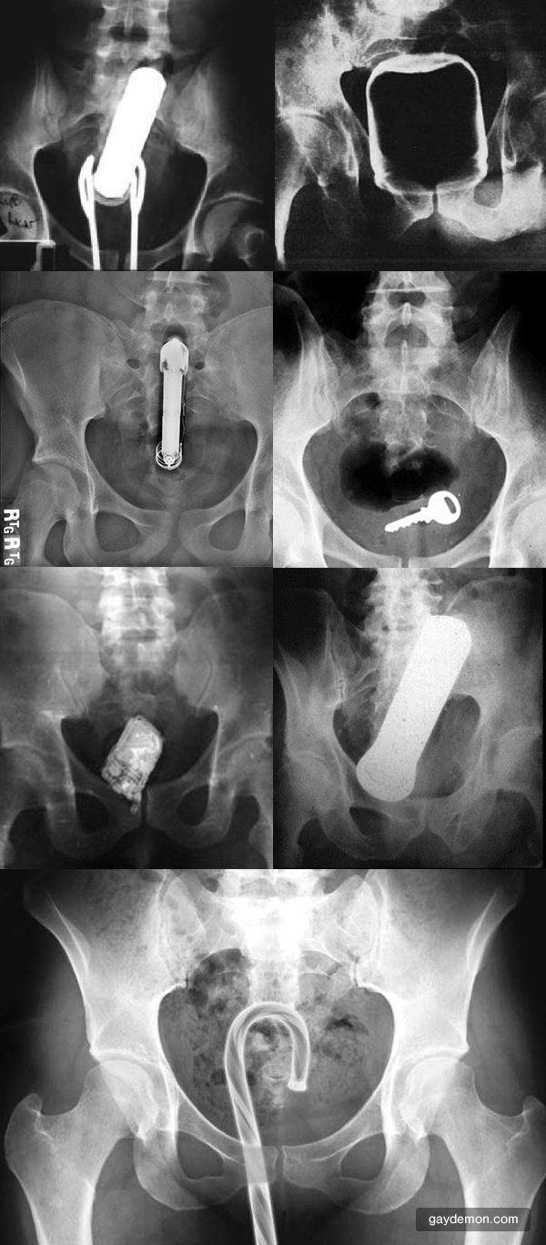 Sex xray X ray